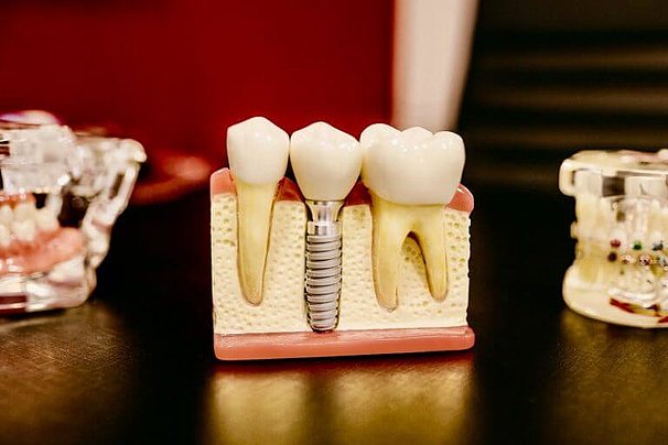 Zahnarzt-nextto-Bellevue-Zahn-Implantate-768x512.jpg 